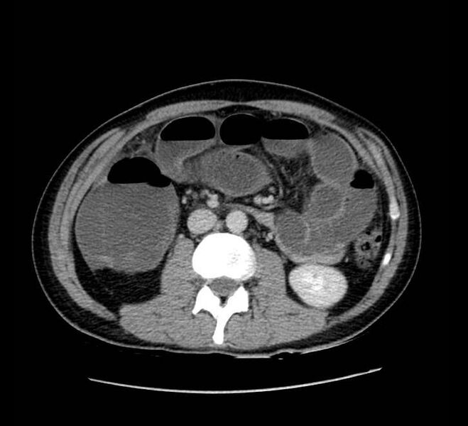 File:Bowel obstruction from colon carcinoma (Radiopaedia 22995-23028 A 40).jpg