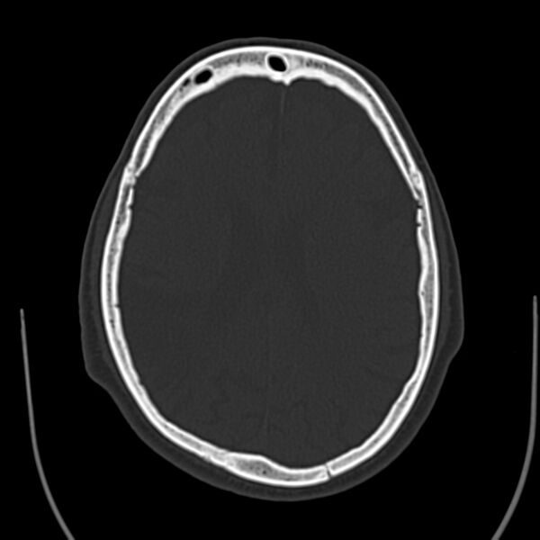 File:Brain Pantopaque remnants (Radiopaedia 78403-91048 Axial bone window 44).jpg