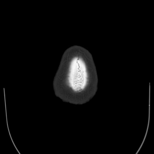 File:Brain Pantopaque remnants (Radiopaedia 78403-91048 Axial bone window 67).jpg