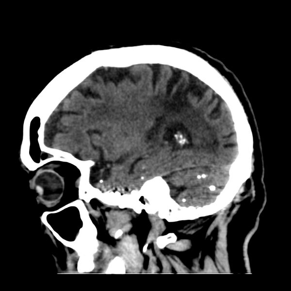 File:Brain Pantopaque remnants (Radiopaedia 78403-91048 C 17).jpg