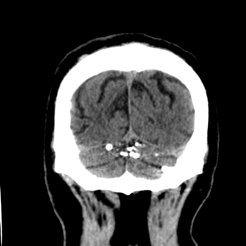 Brain Pantopaque remnants (Radiopaedia 78403-91048 Coronal non-contrast 62).jpg