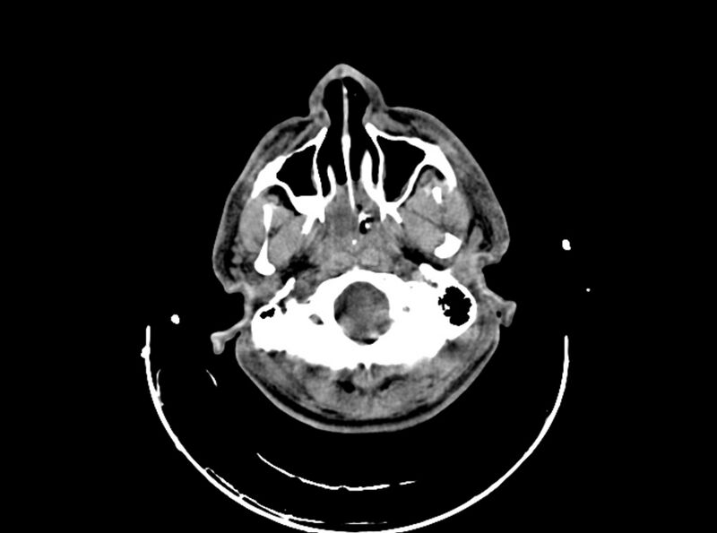 File:Brain injury by firearm projectile (Radiopaedia 82068-96087 B 45).jpg