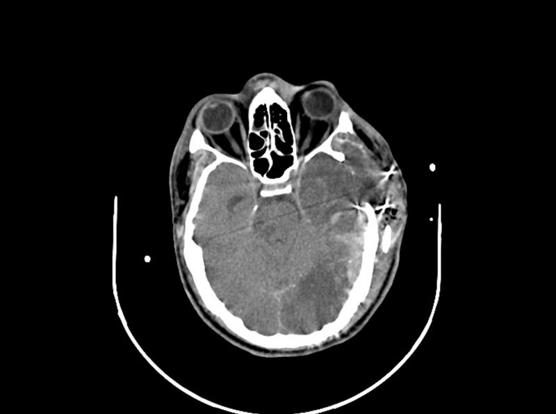 File:Brain injury by firearm projectile (Radiopaedia 82068-96087 B 80).jpg