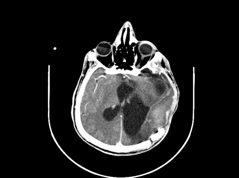 File:Brain injury by firearm projectile (Radiopaedia 82068-96088 B 127).jpg