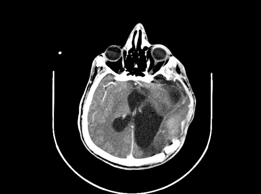 Brain injury by firearm projectile (Radiopaedia 82068-96088 B 127).jpg