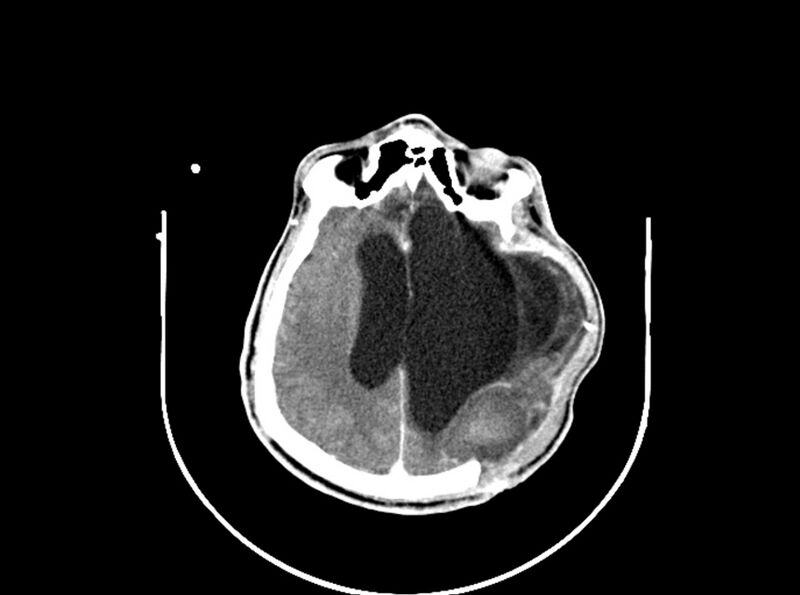 File:Brain injury by firearm projectile (Radiopaedia 82068-96088 B 145).jpg