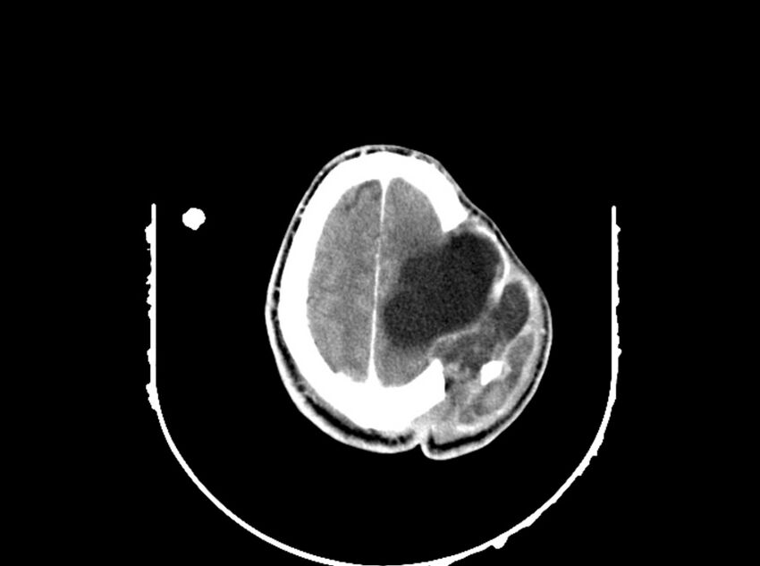 Brain injury by firearm projectile (Radiopaedia 82068-96088 B 179).jpg