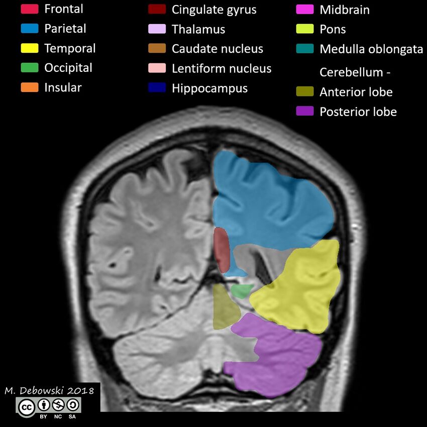Brain lobes - annotated MRI (Radiopaedia 61691-69700 Coronal 53).JPG