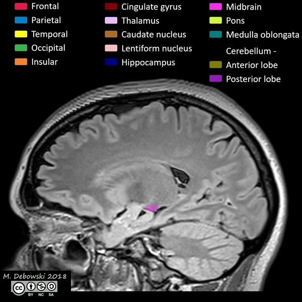 File:Brain lobes - annotated MRI (Radiopaedia 61691-69700 Sagittal 28).JPG