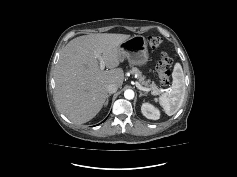 File:Brain metastases from renal cell carcinoma (Radiopaedia 42222-45328 A 8).jpg