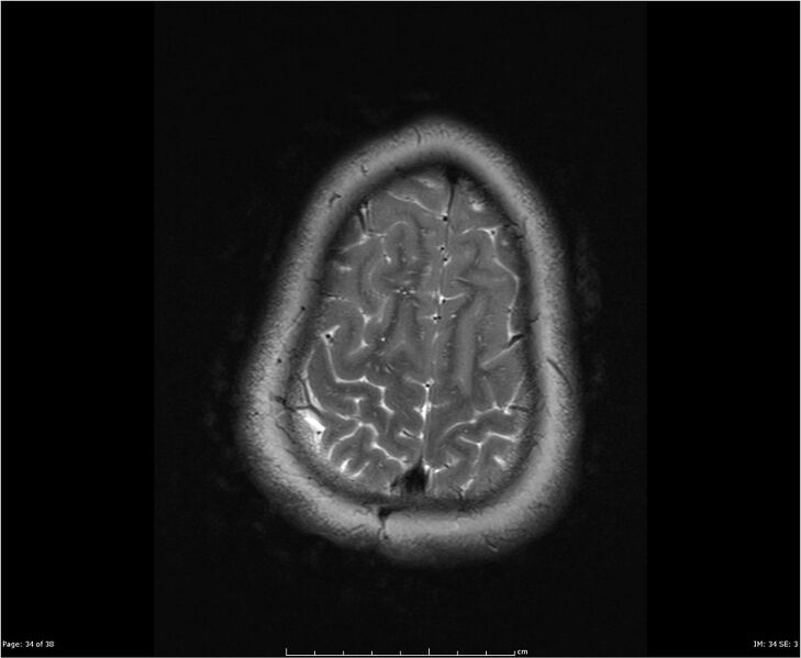 File:Brainstem glioma (Radiopaedia 21819-21775 Axial T2 34).jpg