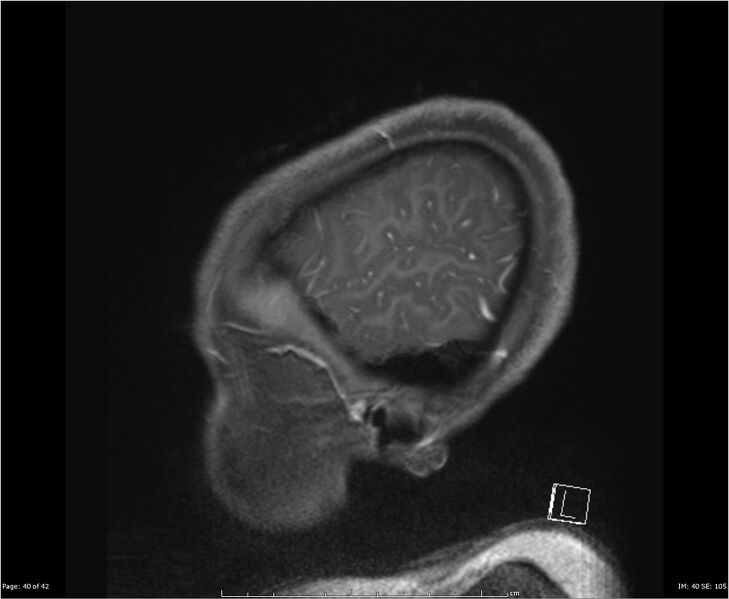 File:Brainstem glioma (Radiopaedia 21819-21775 D 40).jpg