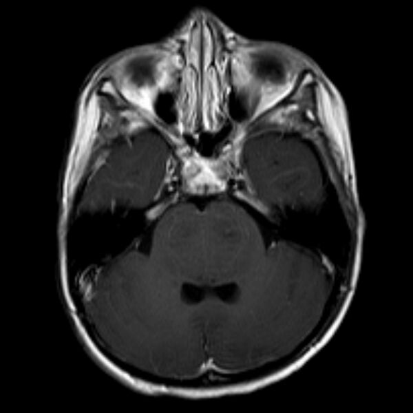 File:Brainstem glioma (Radiopaedia 5683-7390 Axial T1 C+ 1).jpg