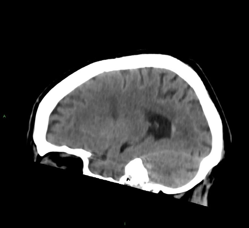 Brainstem hemorrhage (Radiopaedia 58794-66028 C 35).jpg