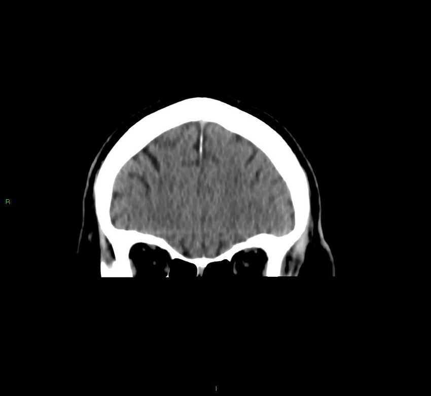 Brainstem hemorrhage (Radiopaedia 58794-66028 Coronal non-contrast 51).jpg