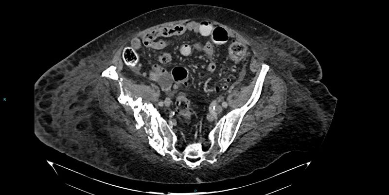 File:Breast cancer pelvic bony metastases (Radiopaedia 84470-99824 Axial bone window 36).jpg