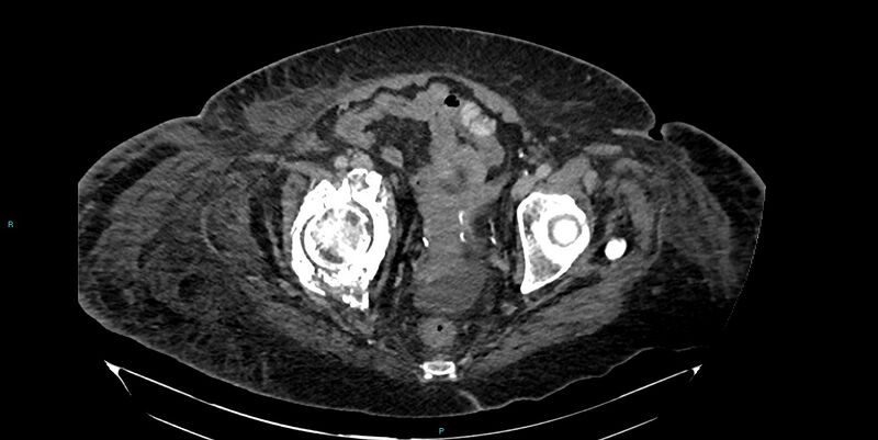File:Breast cancer pelvic bony metastases (Radiopaedia 84470-99824 Axial bone window 52).jpg