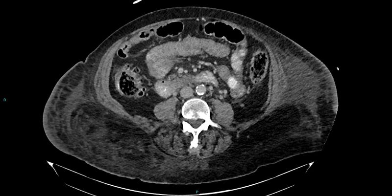 File:Breast cancer pelvic bony metastases (Radiopaedia 84470-99824 Axial bone window 9).jpg