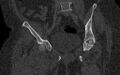 Breast carcinoma with pathological hip fracture (Radiopaedia 60314-67993 Coronal bone window 68).jpg