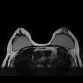 Breast implants - MRI (Radiopaedia 26864-27035 Axial T2 30).jpg
