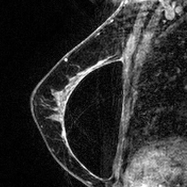 File:Breast implants - MRI (Radiopaedia 26864-27035 Sagittal T2 96).jpg
