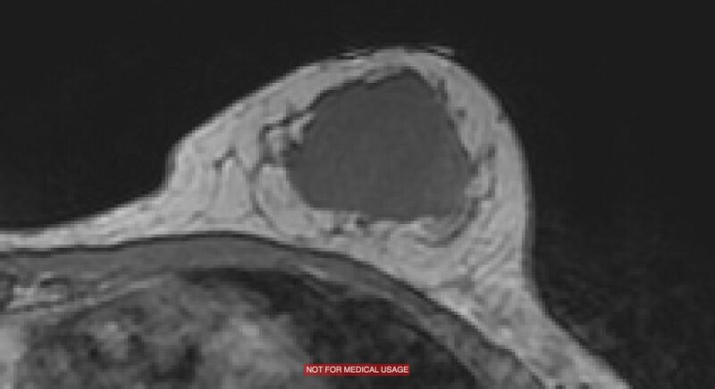 File:Breast lymphoma (MRI) (Radiopaedia 34999-36498 Axial T1 12).jpg