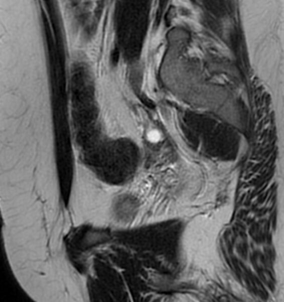 File:Broad ligament leiomyoma (Radiopaedia 81634-95516 Sagittal T2 22).jpg