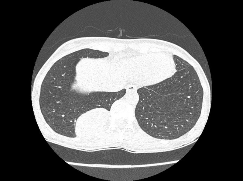 File:Bronchogenic cyst (Radiopaedia 80273-93615 Axial lung window 21).jpg