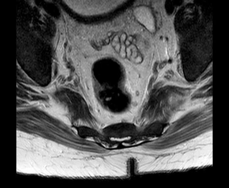 File:Brown tumors compressing the spinal cord (Radiopaedia 68442-78030 Axial T2 - lumbar 3).jpg
