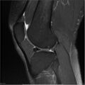 Bucket handle tear - lateral meniscus (Radiopaedia 7246-8187 Sagittal T2 fat sat 9).jpg
