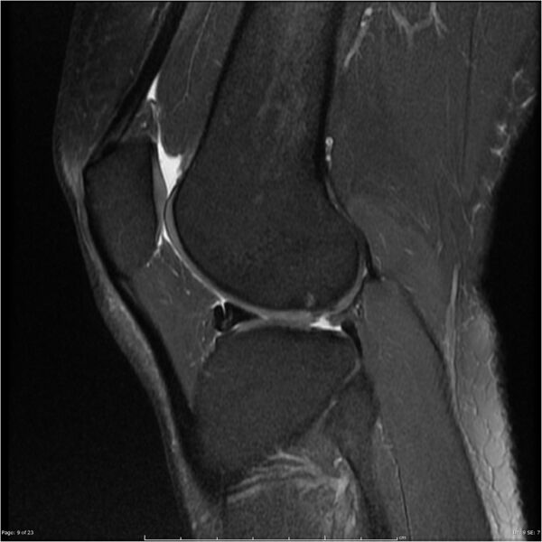 File:Bucket handle tear - lateral meniscus (Radiopaedia 7246-8187 Sagittal T2 fat sat 9).jpg