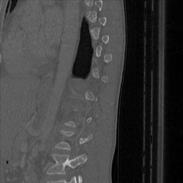 File:Bulging of paraspinal line in traumatic thoracal spinal compression fracture (Radiopaedia 29221-35872 Sagittal bone window 47).jpg
