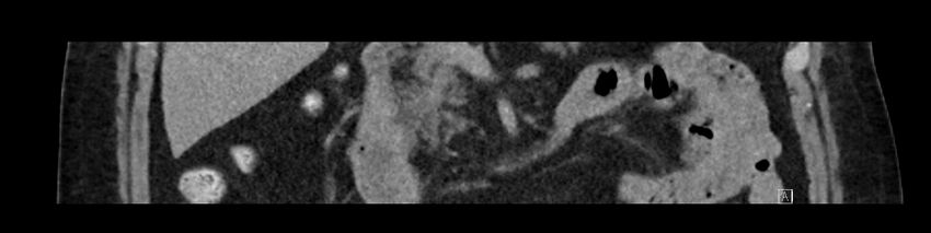 Buried bumper syndrome - gastrostomy tube (Radiopaedia 63843-72575 Coronal Inject 44).jpg