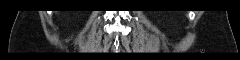File:Buried bumper syndrome - gastrostomy tube (Radiopaedia 63843-72575 Coronal Inject 83).jpg