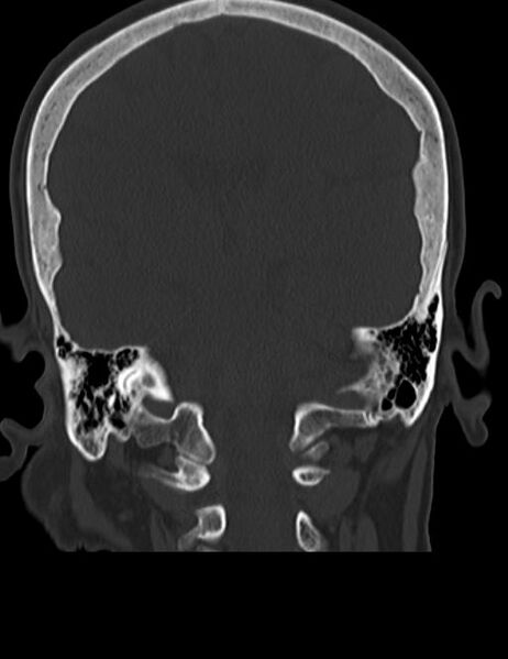 File:Burnt-out meningioma (Radiopaedia 51557-57337 Coronal bone window 33).jpg