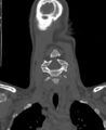 Butterfly vertebra (Radiopaedia 77903-90209 Coronal bone window 11).jpg