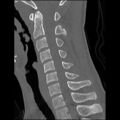 C5 facet fracture (Radiopaedia 58374-65499 Sagittal bone window 37).jpg