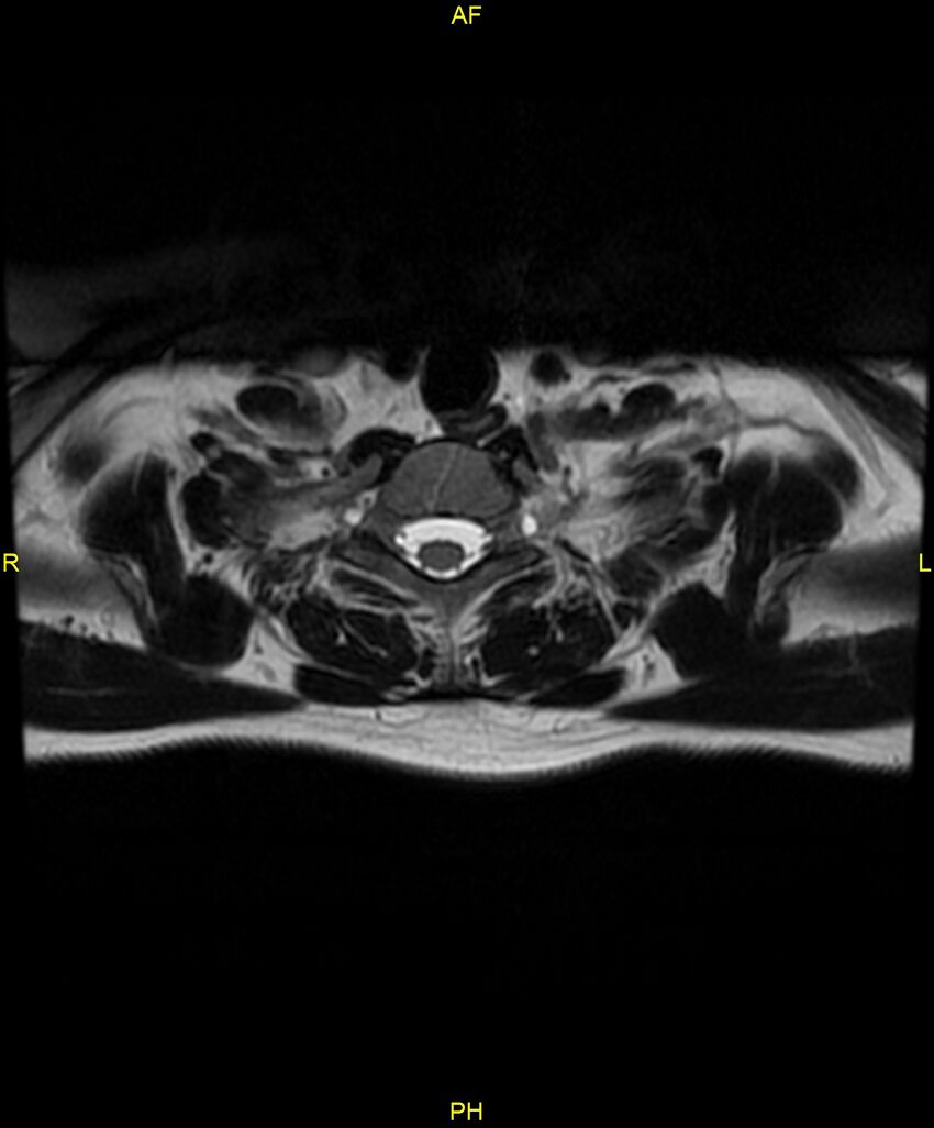 C5 nerve sheath tumor (Radiopaedia 85777-101596 Axial T2 77).jpg