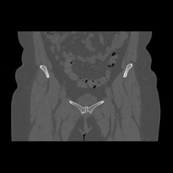 File:Calcific tendinitis of the gluteus medius muscle (Radiopaedia 66998-76318 Coronal bone window 15).jpg
