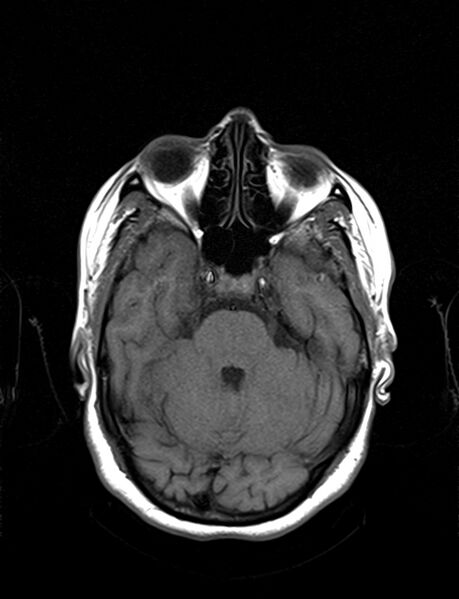 File:Calcified cerebral hydatid cyst (Radiopaedia 65603-74699 Axial T1 7).jpg