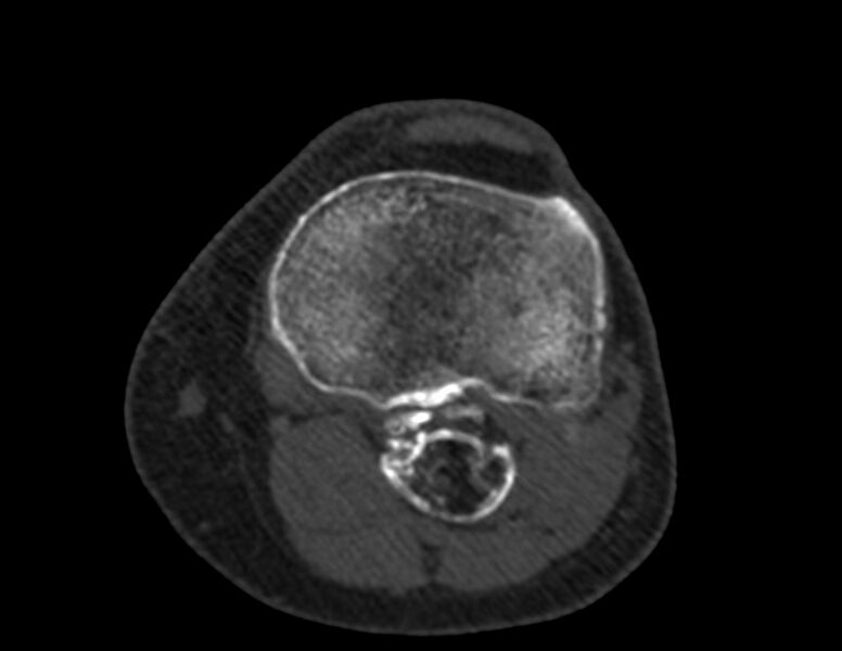 File:Calcified hematoma - popliteal fossa (Radiopaedia 63938-72763 Axial bone window 49).jpg