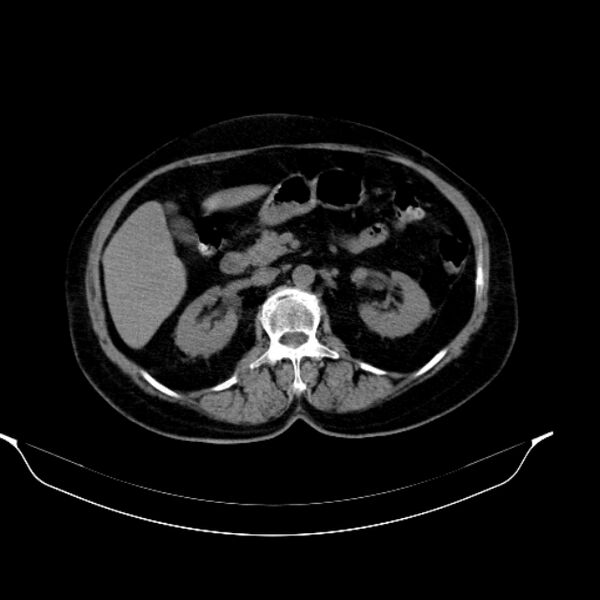 File:Calcified hydatid cyst (Radiopaedia 62000-70085 Axial non-contrast 45).jpg