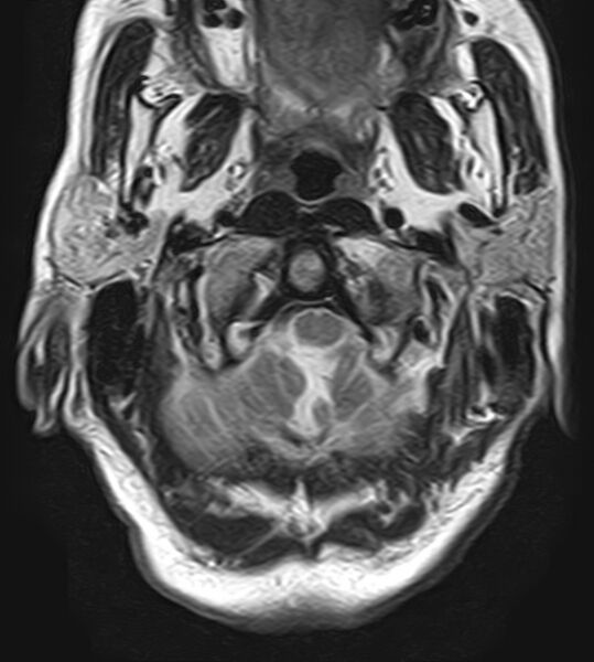 File:Calcified meningioma - cervical canal (Radiopaedia 70136-82468 Axial T2 3).jpg