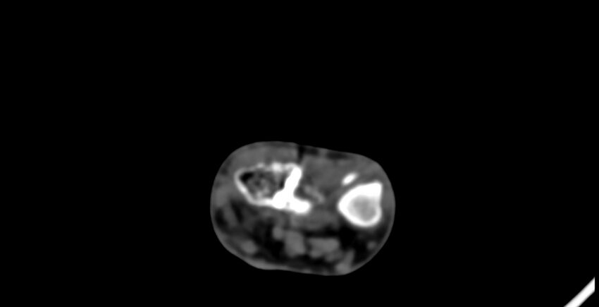 Calcifying aponeurotic fibroma (Radiopaedia 88423-105064 B 29).jpg