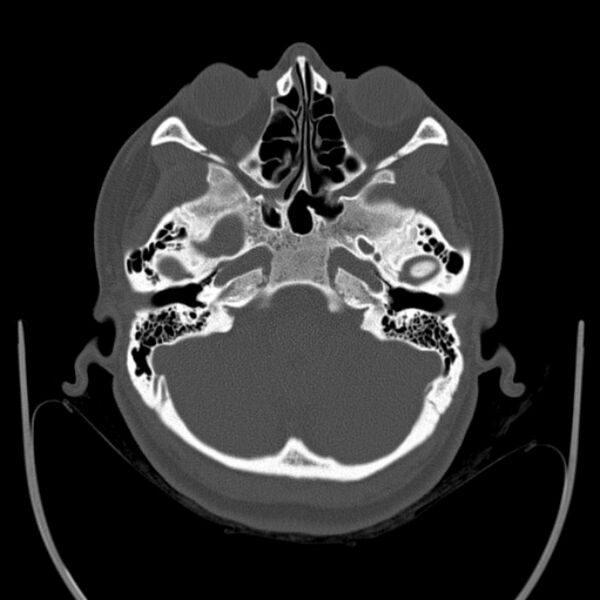 File:Calvarial osteoma (Radiopaedia 36520-38079 Axial bone window 23).jpg