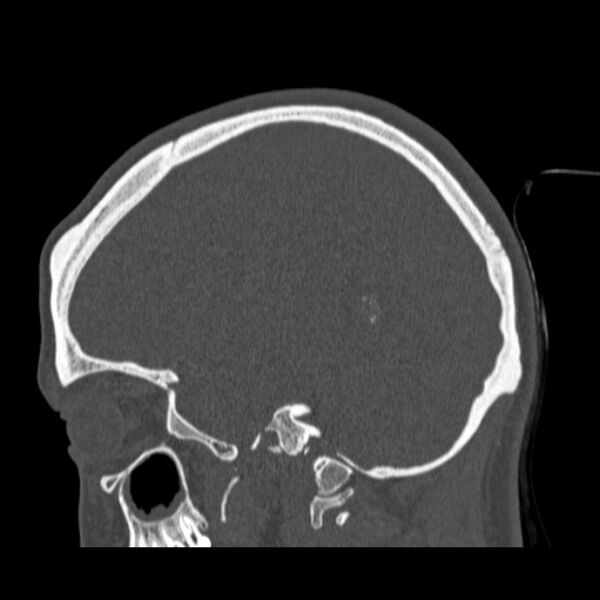 File:Calvarial osteoma (Radiopaedia 36520-38079 Sagittal bone window 39).jpg