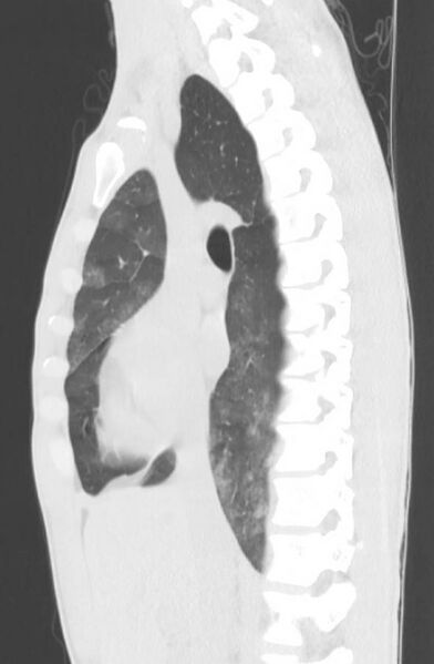 File:Cannabis-induced diffuse alveolar hemorrhage (Radiopaedia 89834-106946 Sagittal lung window 61).jpg