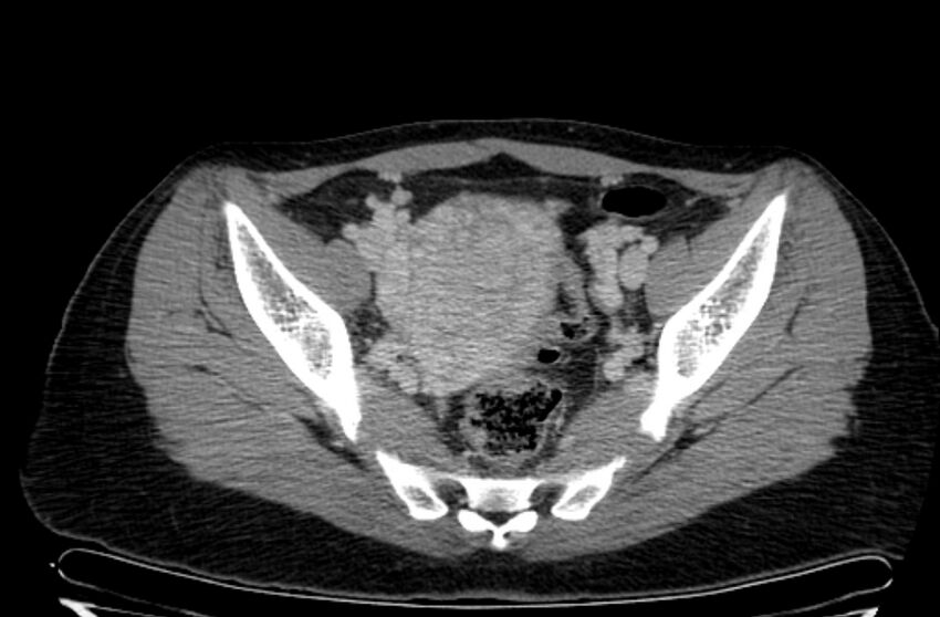 Cannonball metastases - uterine choriocarcinoma (Radiopaedia 70137-80174 A 20).jpg