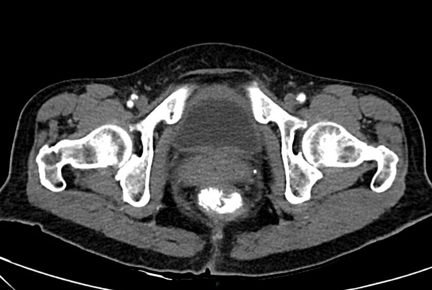 Carcinoid mesenteric tumor complicated by chylous ascites (Radiopaedia 76312-88926 A 76).jpg