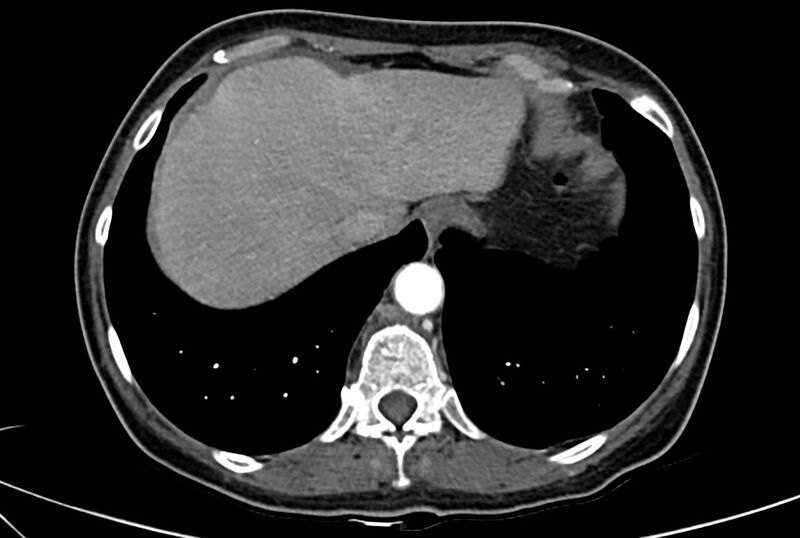 File:Carcinoid mesenteric tumor complicated by chylous ascites (Radiopaedia 76312-88926 A 8).jpg